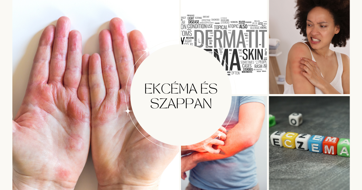 ekcéma kezelése